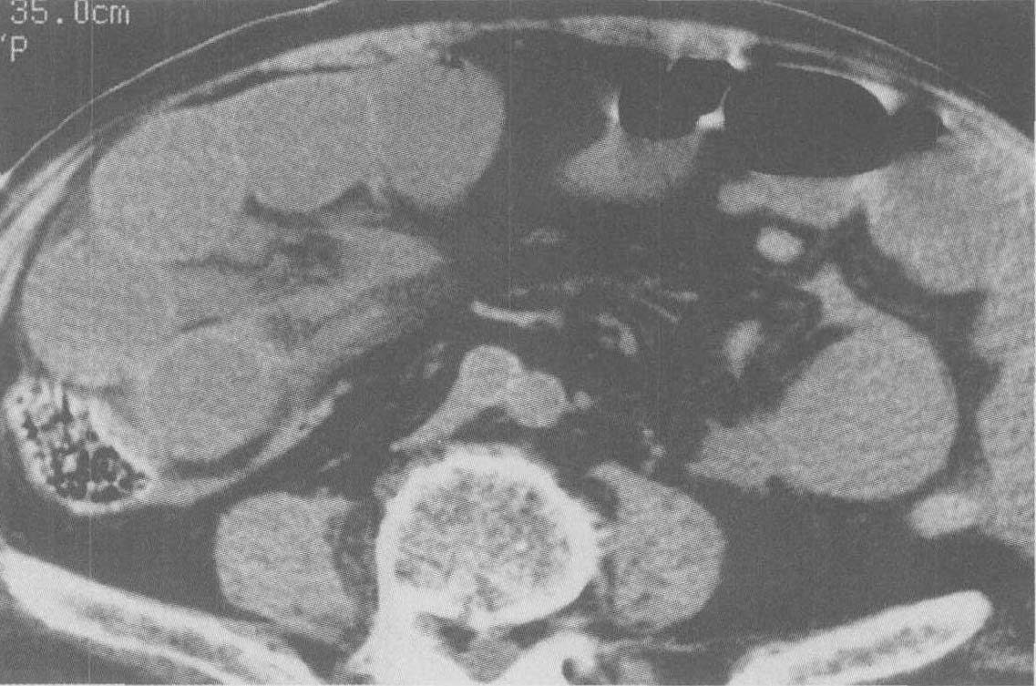 絞窄性腸梗阻