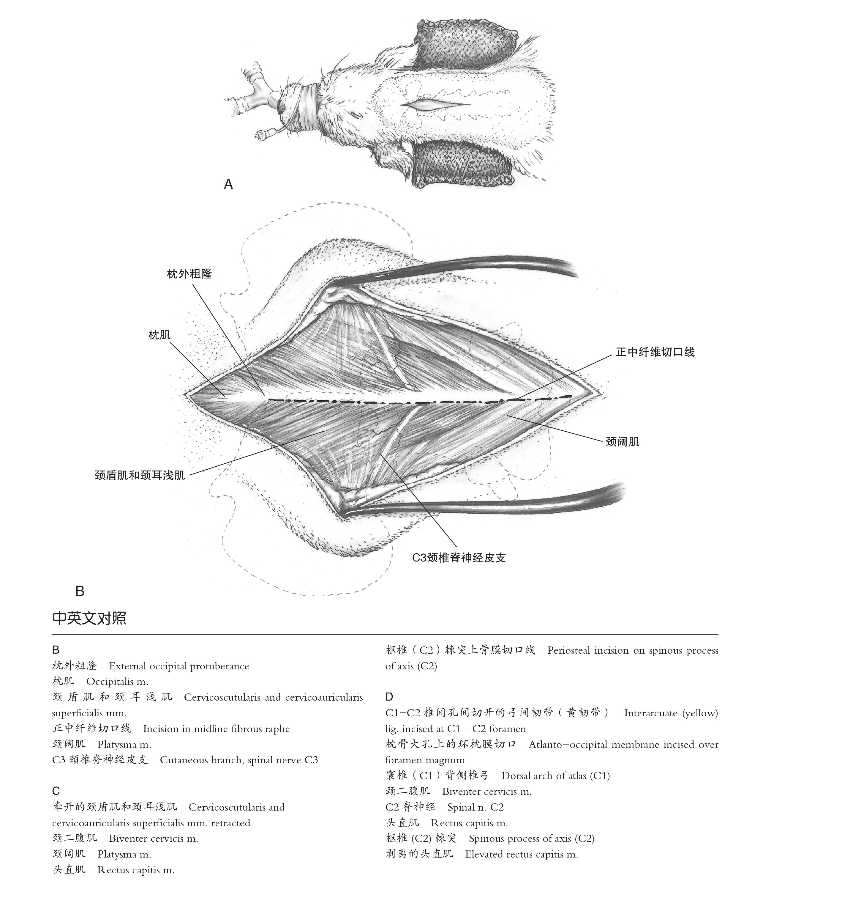 3.4 中段頸椎背側(cè)切開手術(shù)入路
